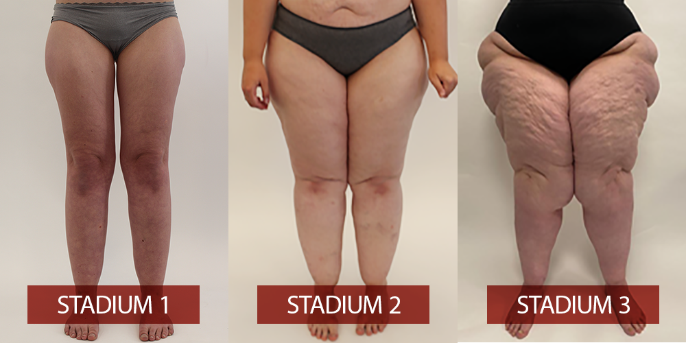 Stadien und Typen des Lipödems - LipoZentrum Dr. Heck in Salzburg