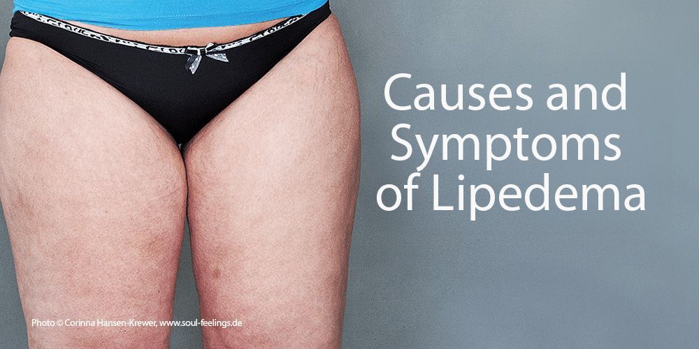 Causes and Symptoms of Lipedema