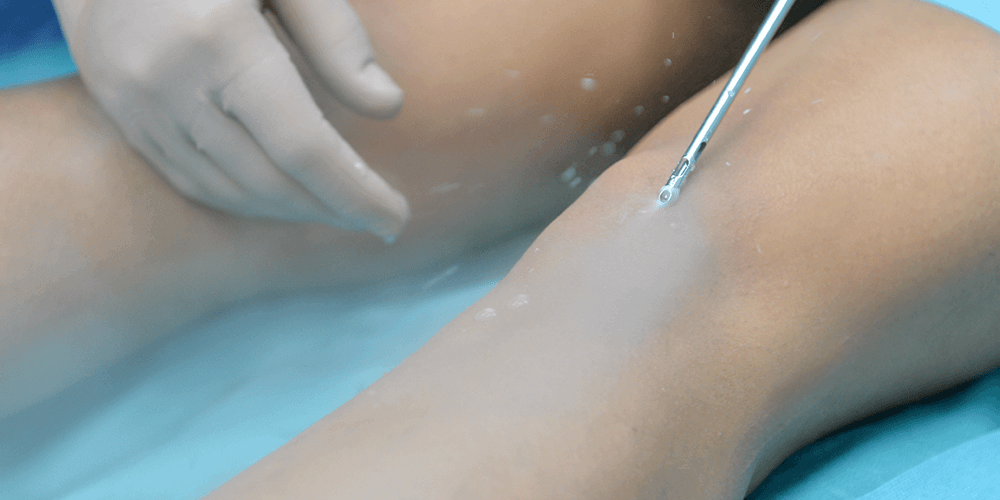 Operative Therapie des Lipödems - LipoZentrum Dr. Heck in Salzburg
