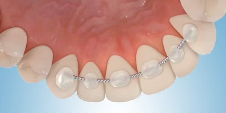 Close-up of lower teeth with braces and clear aligners on pink gums