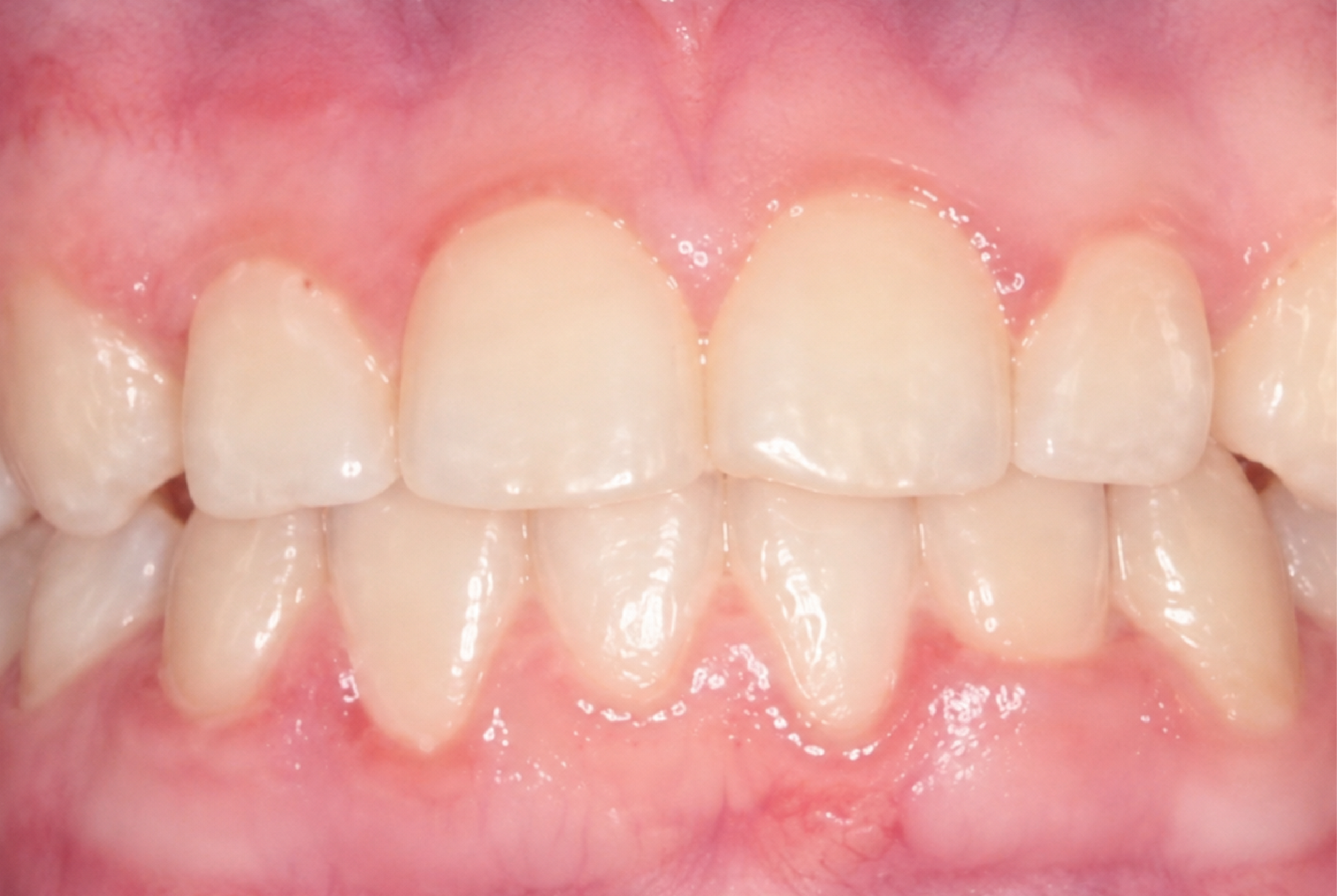 Braces Doc Before and After