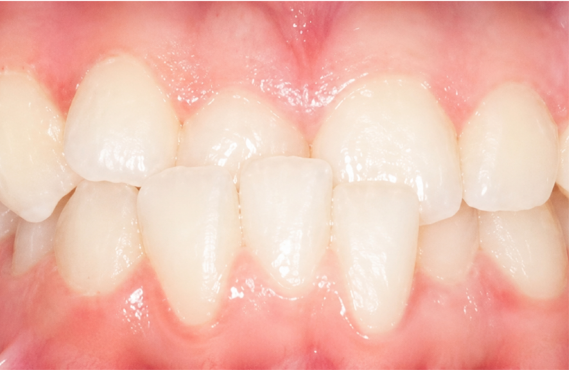 Braces Doc Before and After