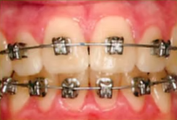 Close-up of teeth with metal braces and brackets on upper and lower teeth
