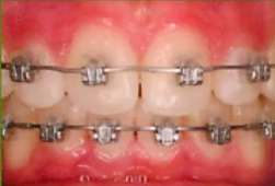 Close-up of teeth with braces and red, irritated gums