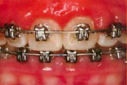 Close-up of teeth with metal braces and archwires on upper and lower rows, gums visible