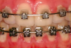Close-up of teeth with metal braces and pink gums