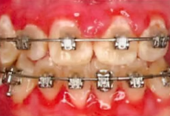 Close-up of teeth with metal braces and red, irritated gums
