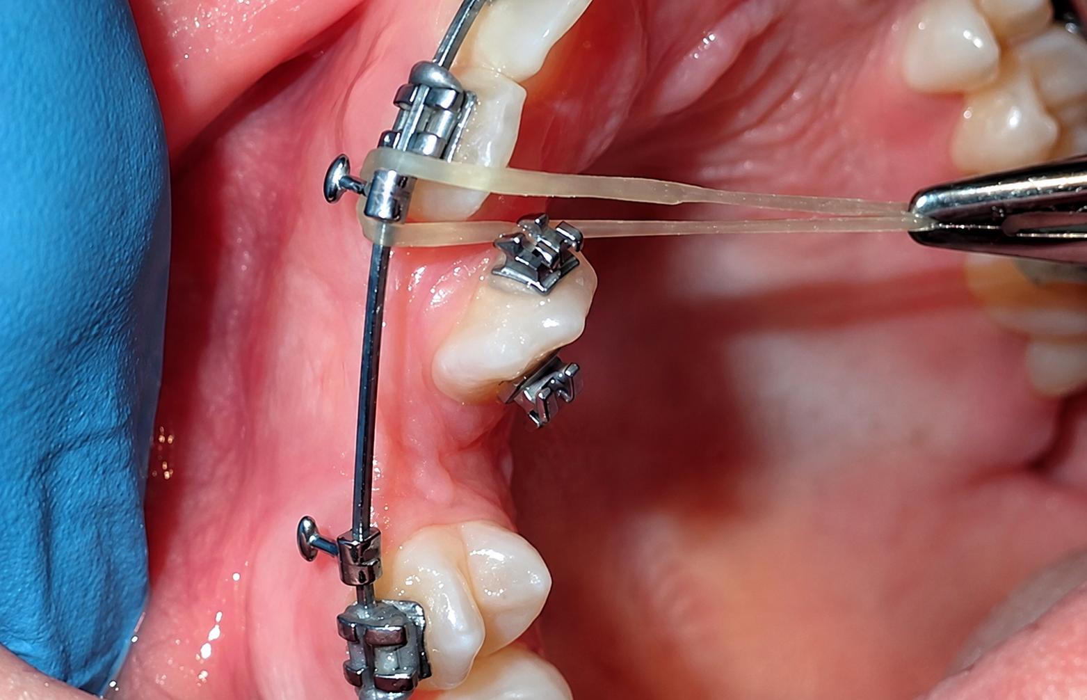 SLINGSHOT ELASTICS Step 1