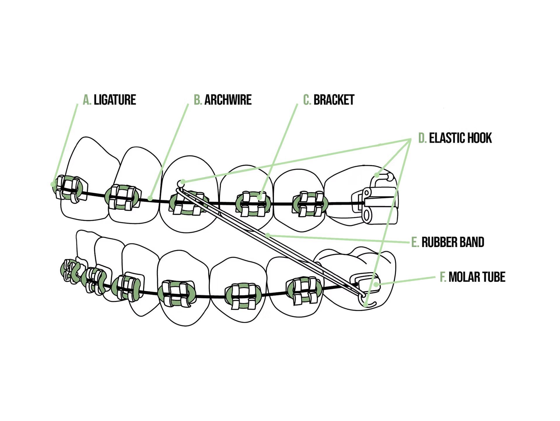 Braces diagram showing bracket, archwire, ligature, elastic hook, and power chain parts