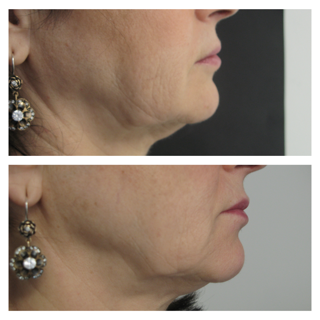 patient at dermatology partners before and after face contouring