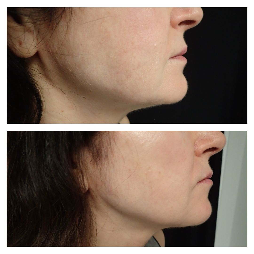 patient at dermatology partners before and after face contouring