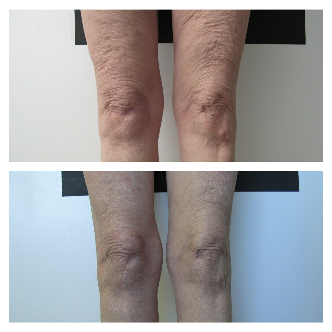 patient at dermatology partners before and after body contouring on legs