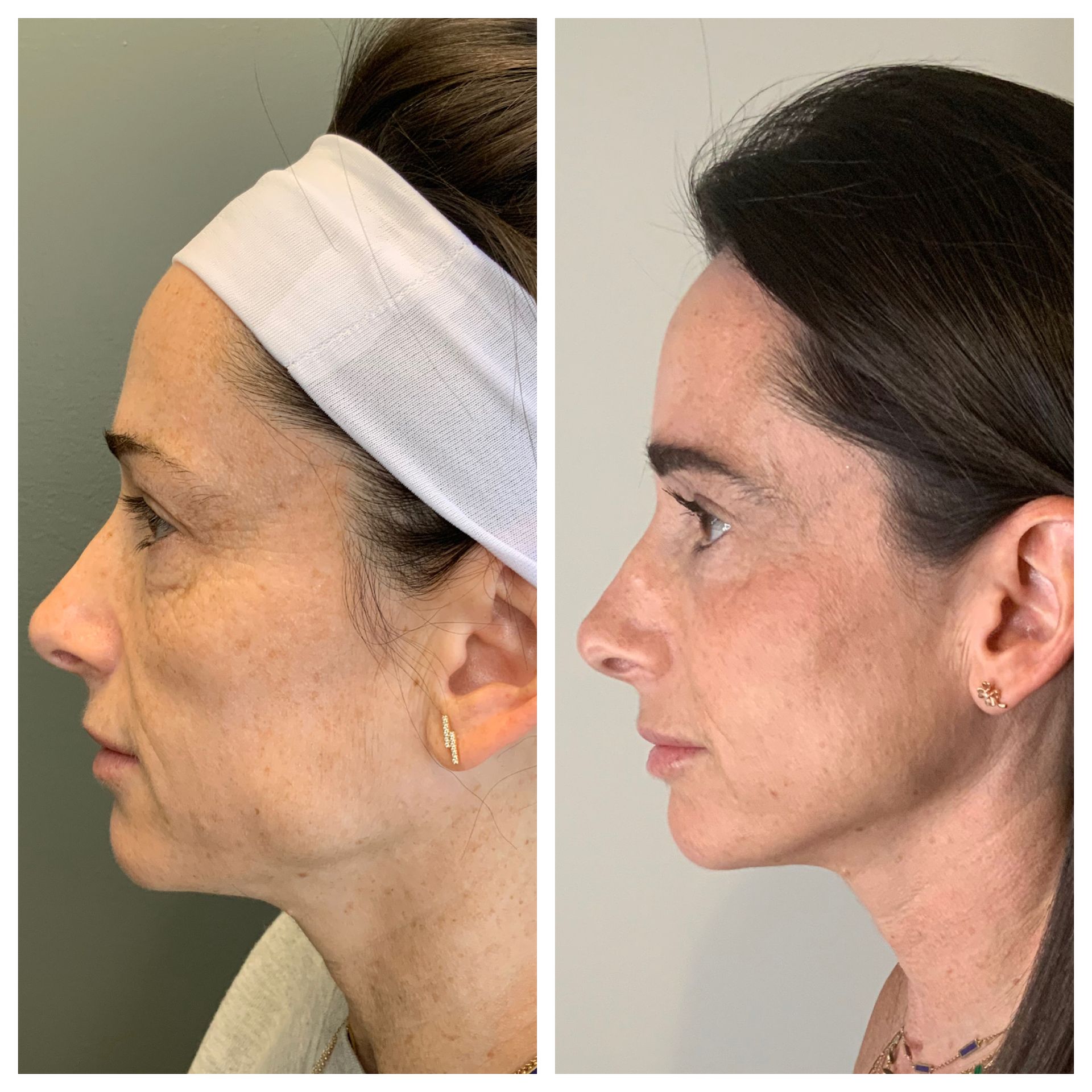 patient before and after Facial Balancing & Laser Combo - dermatology partners