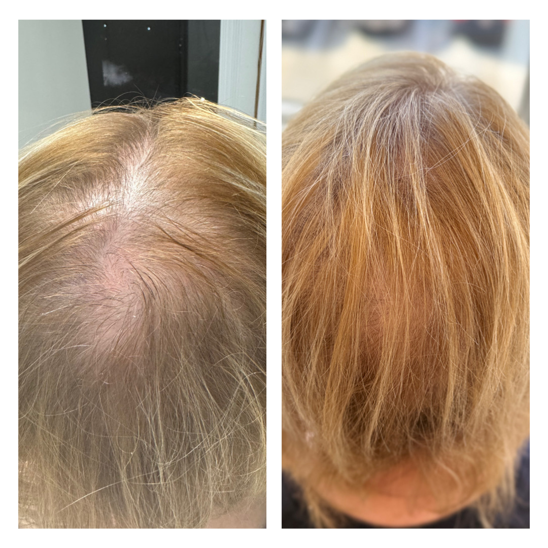patient at dermatology partners before and after hair loss treatment keralase