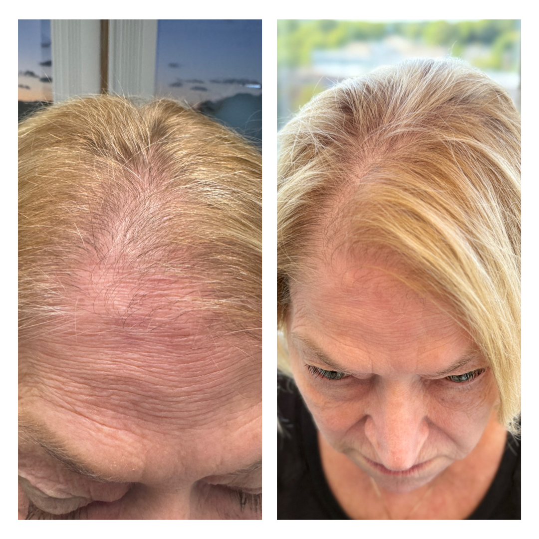 patient at dermatology partners before and after hair loss treatment keralase