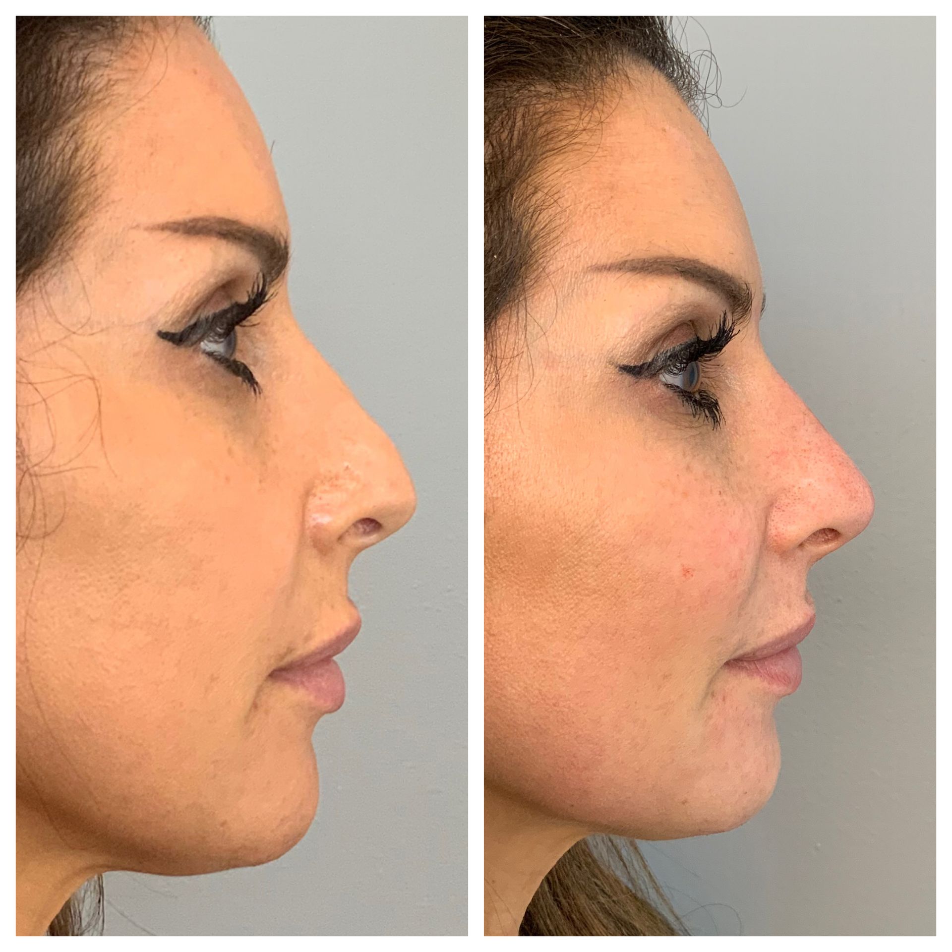 patient before and after Liquid Nose Job injectables - dermatology partners