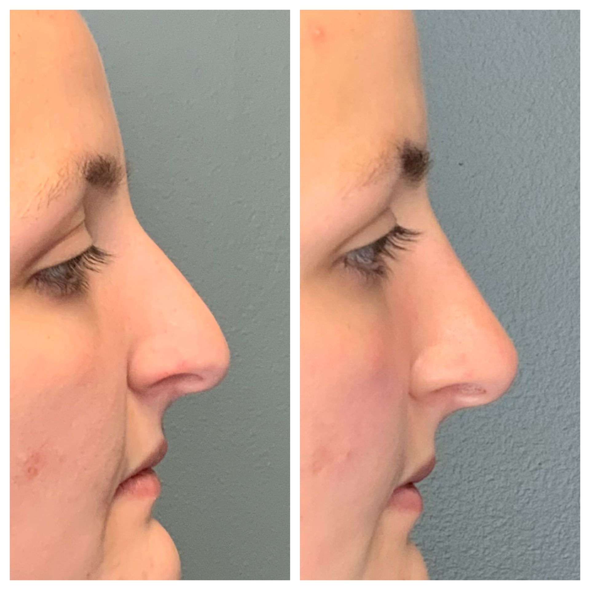 patient before and after Liquid Nose Job injectables - dermatology partners