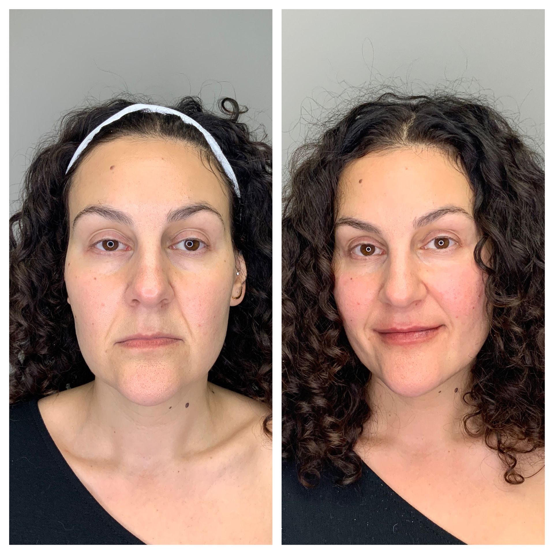 patient before and after Facial Balancing  - dermatology partners
