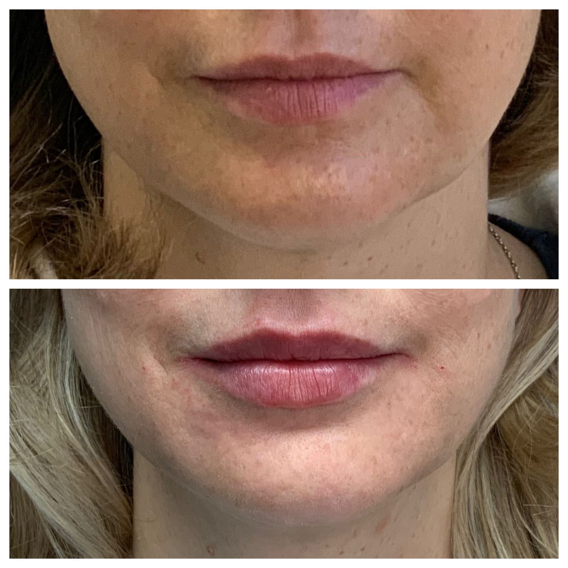 patient at dermatology partners before and after lip filler