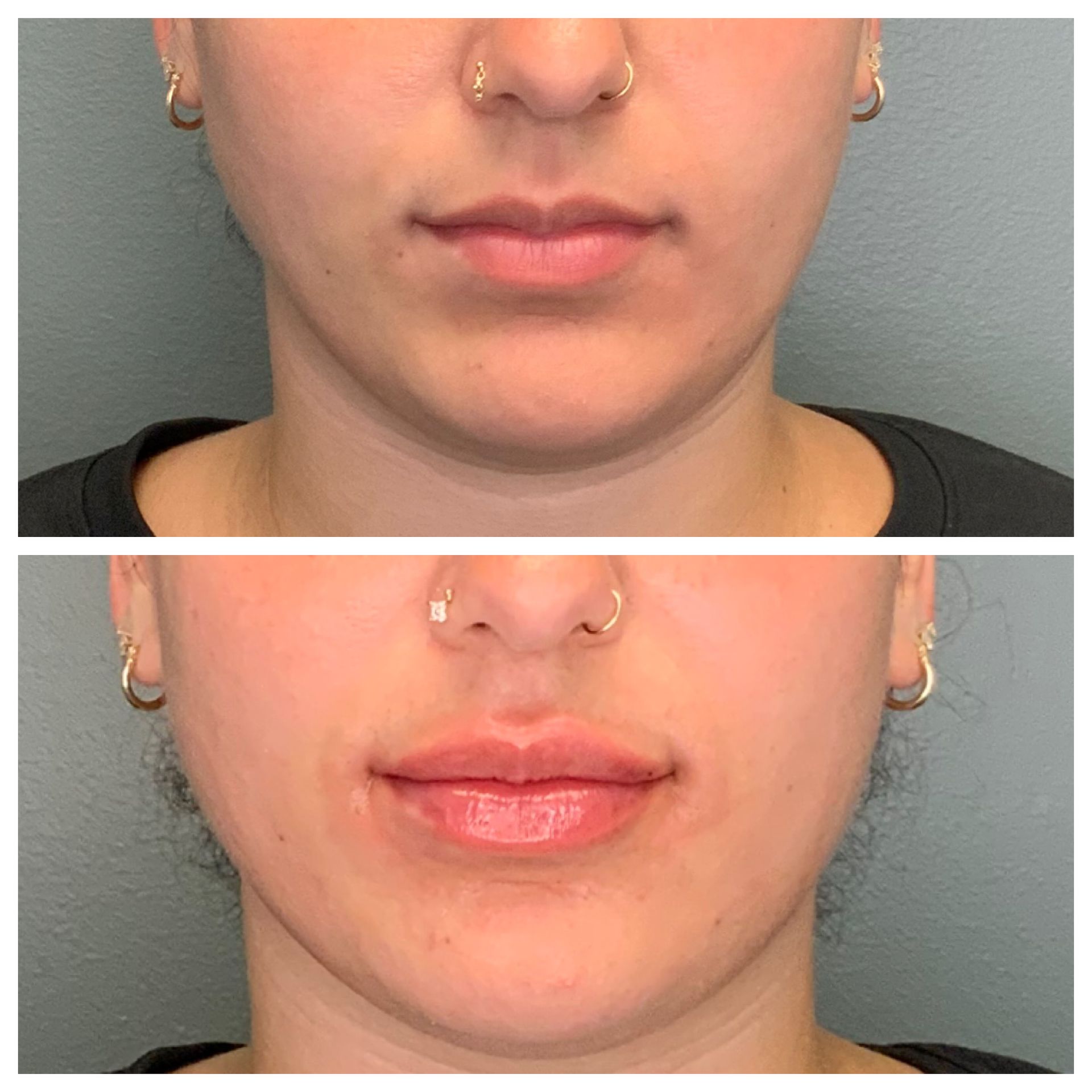 patient at dermatology partners before and after lip filler