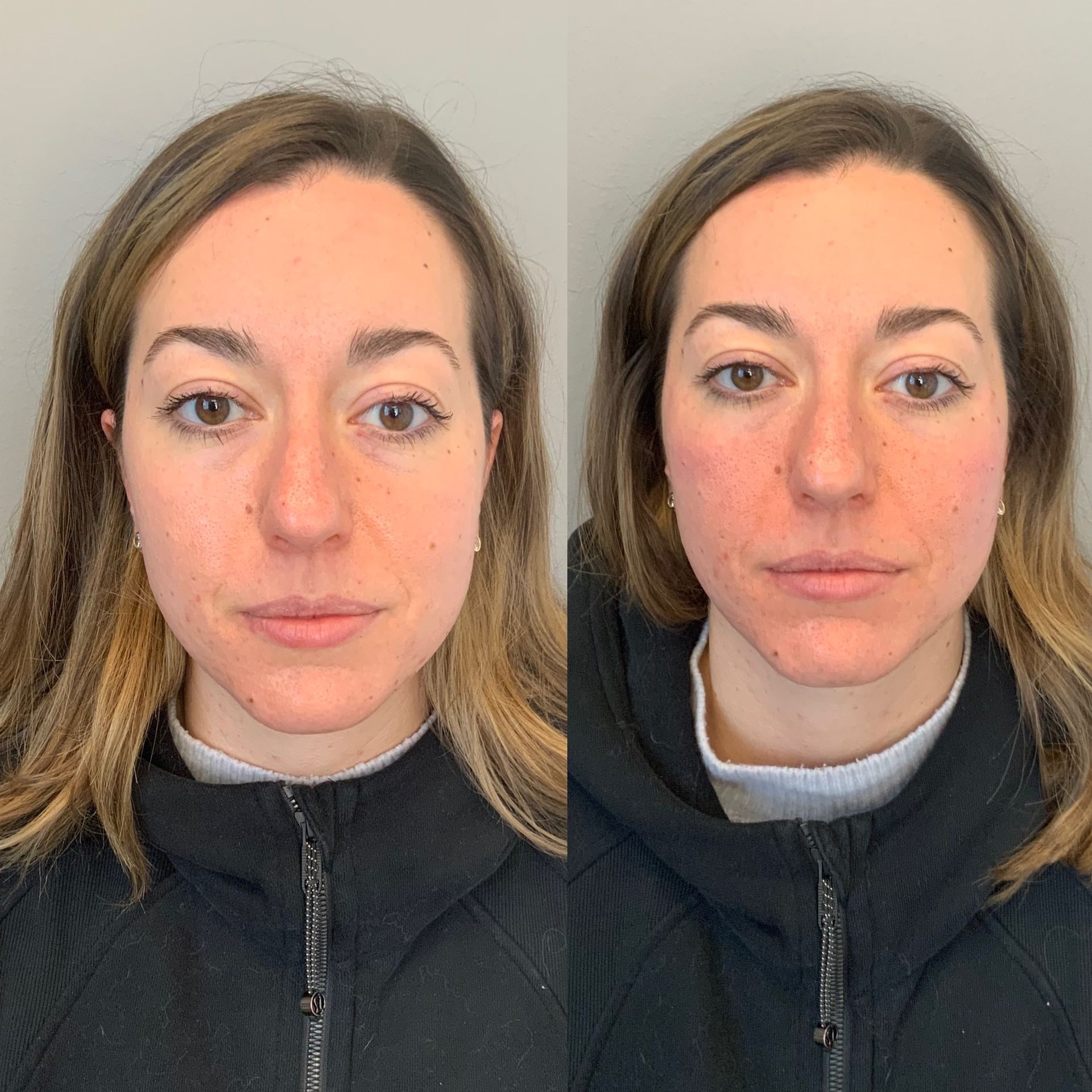 before and after skin treatment at dermatology partners boston