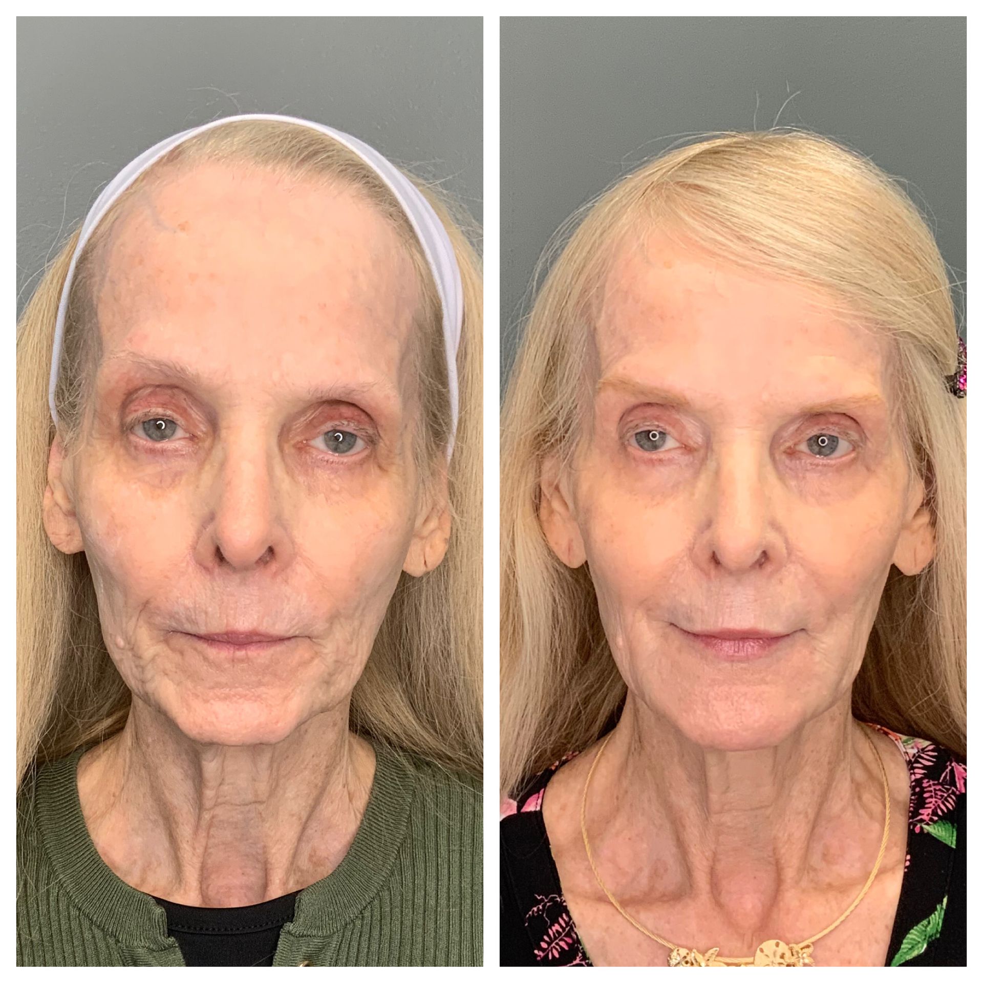 patient before and after Facial Balancing  - dermatology partners