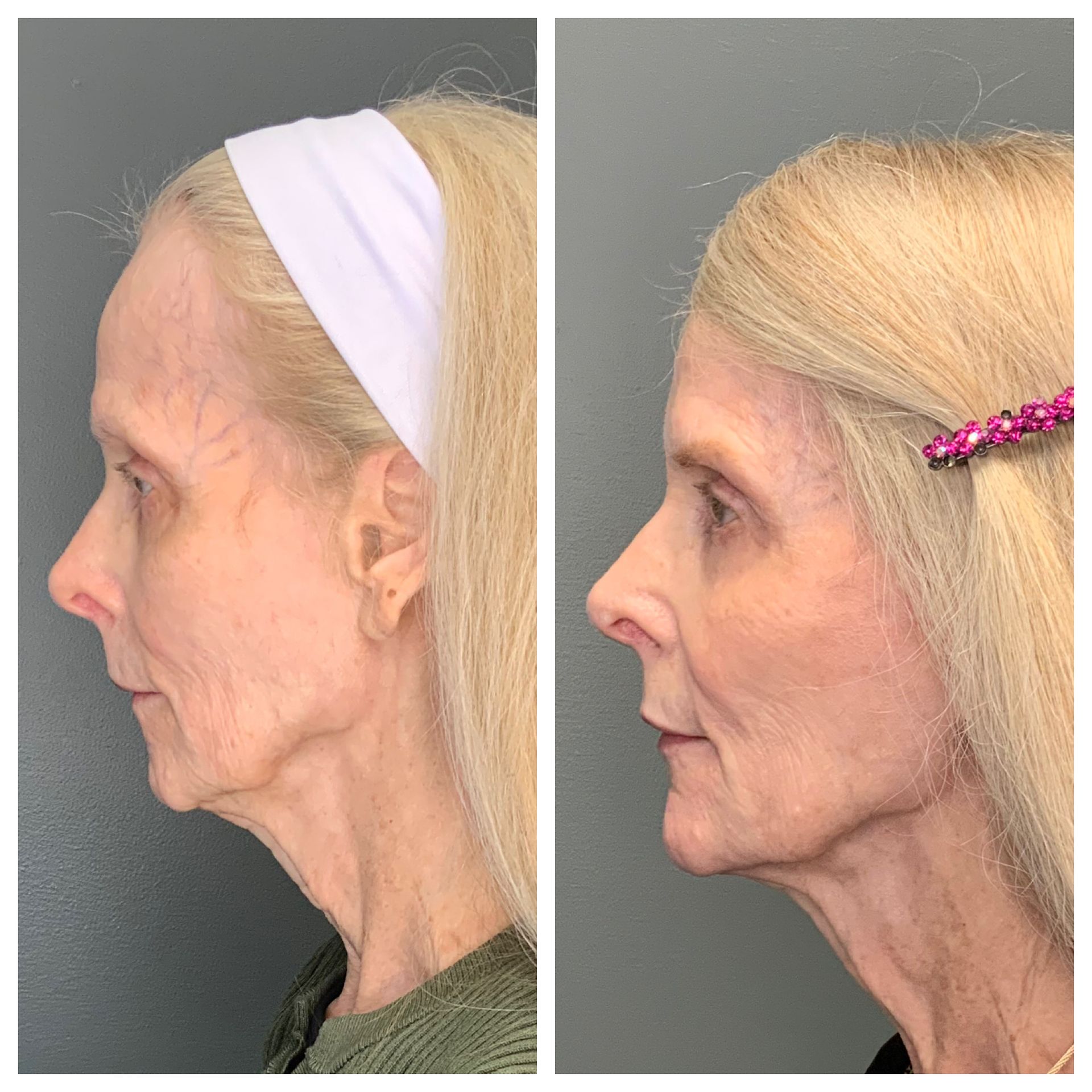 before and after skin treatment at dermatology partners boston