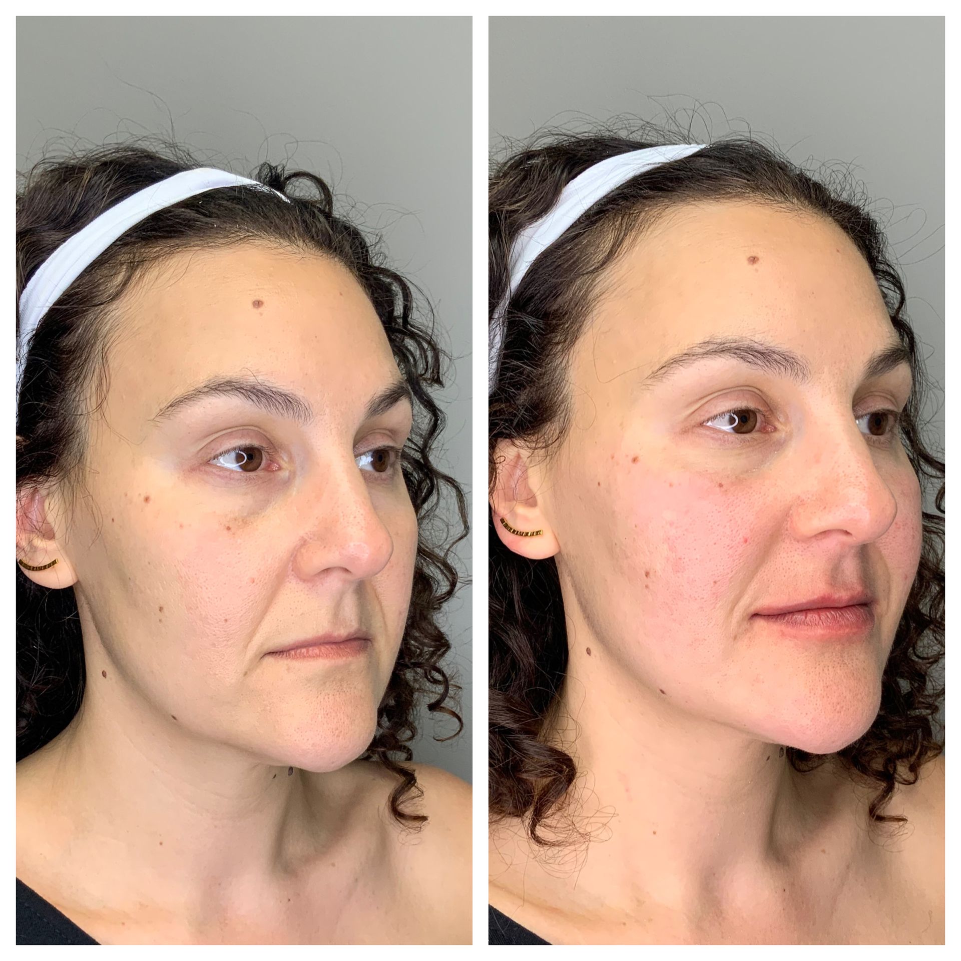 before and after skin treatment at dermatology partners boston