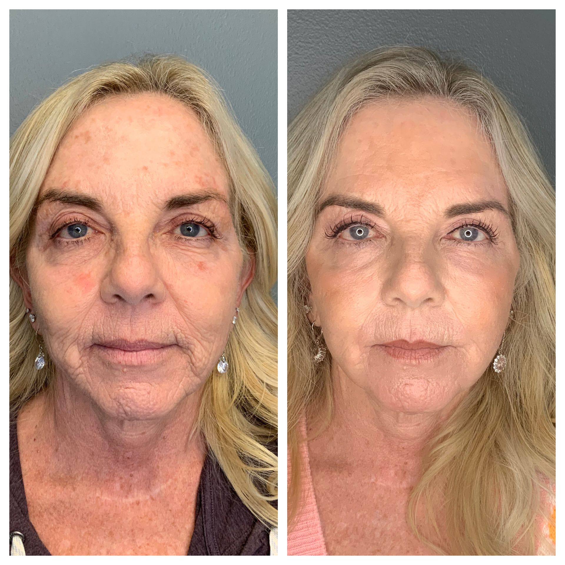 patient before and after Facial Balancing & Laser Combo - dermatology partners
