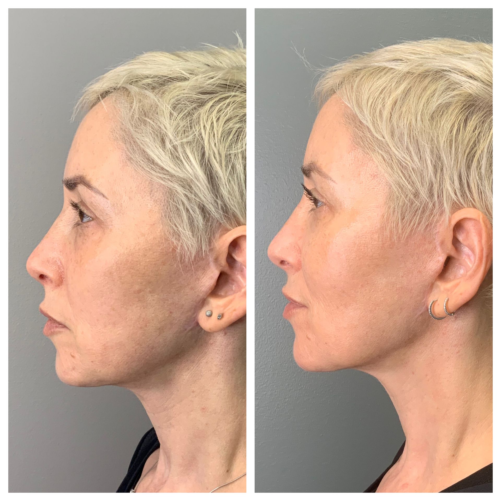 patient before and after Facial Balancing & Laser Combo - dermatology partners