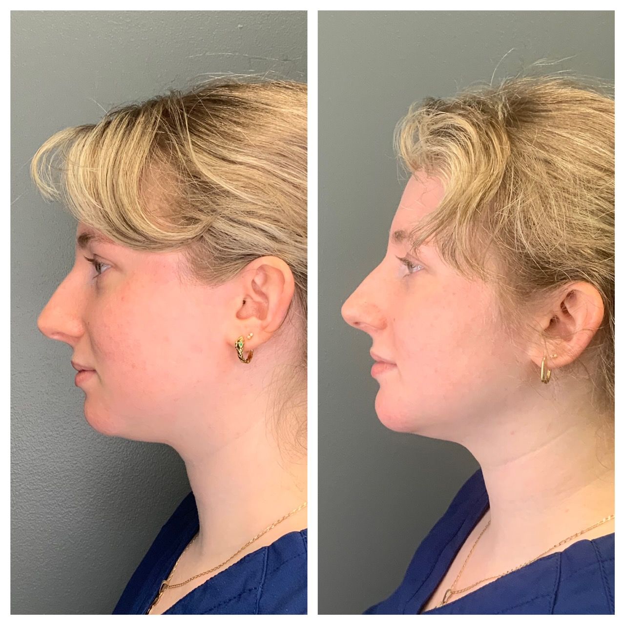 patient before and after Facial Balancing  - dermatology partners