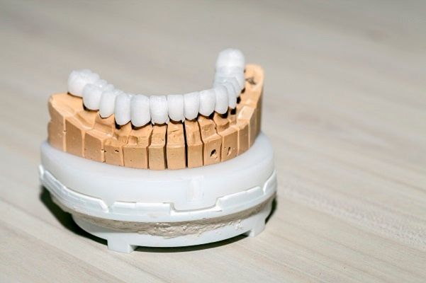 All You Need To Know About Porcelain Veneers