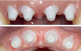 Ceramic Implant Restorations