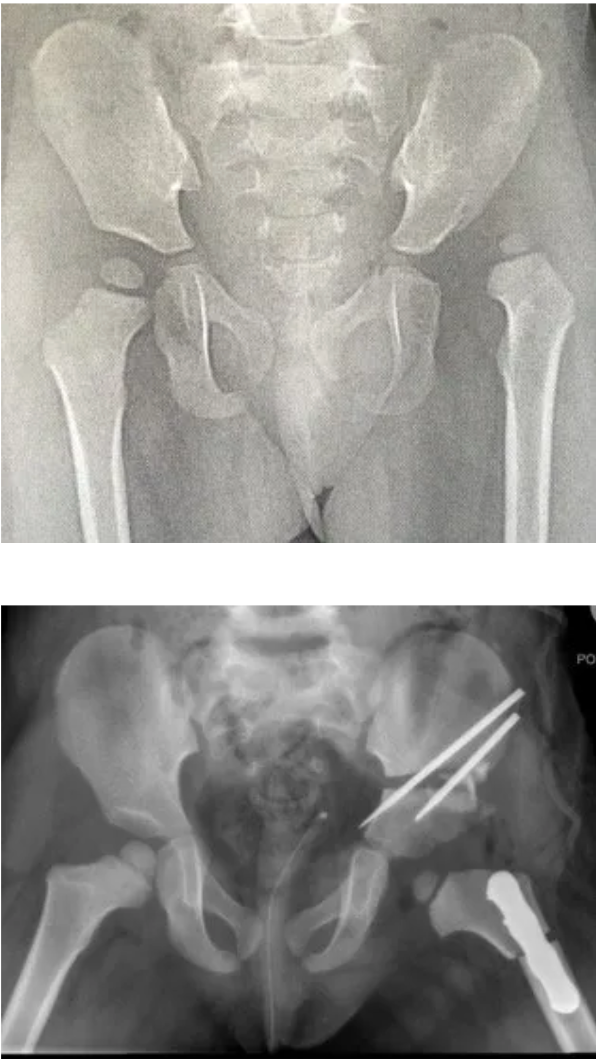 Baby Hip Dysplasia (DDH)