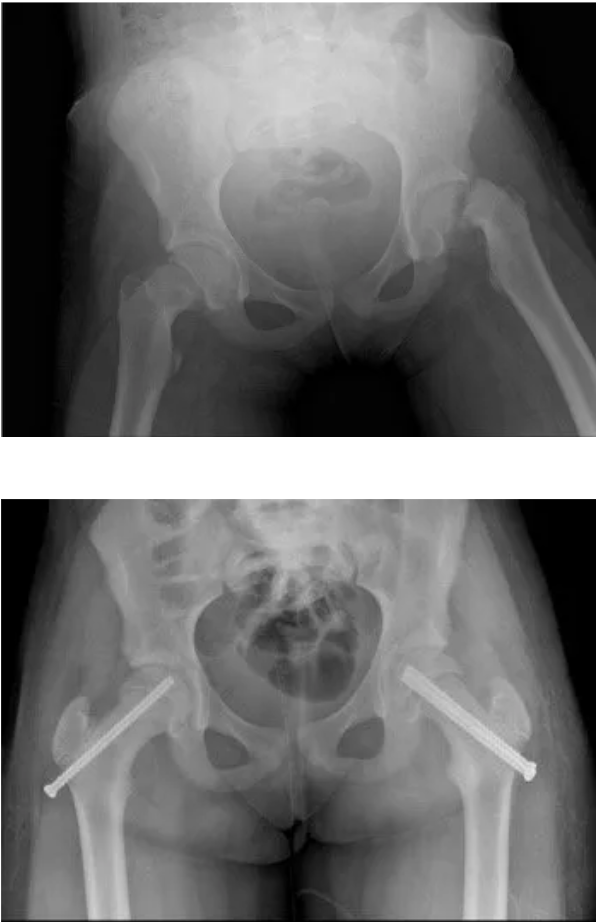 Slipped Capital Femoral Epiphysis