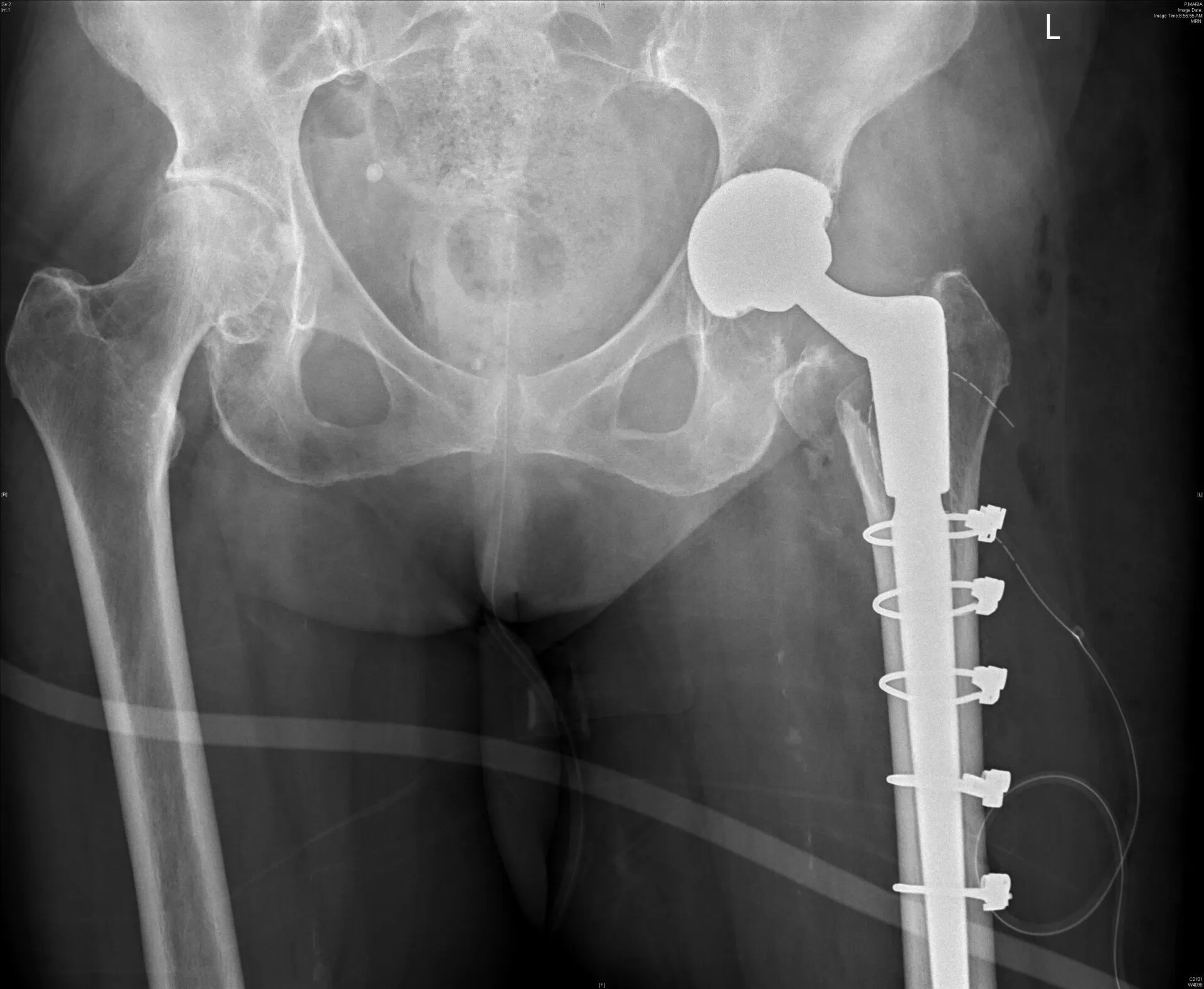 Revision (re-do) Hip Replacement