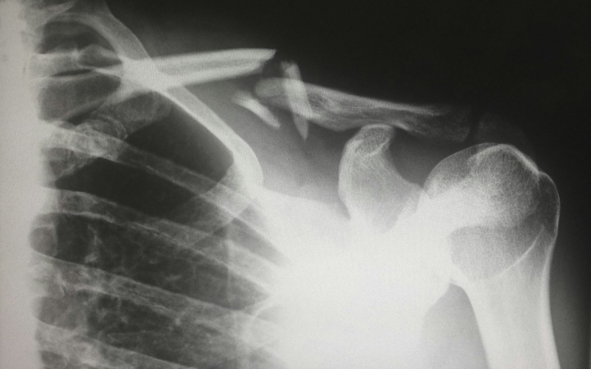 X-ray of a shoulder showing the clavicle and upper arm bones