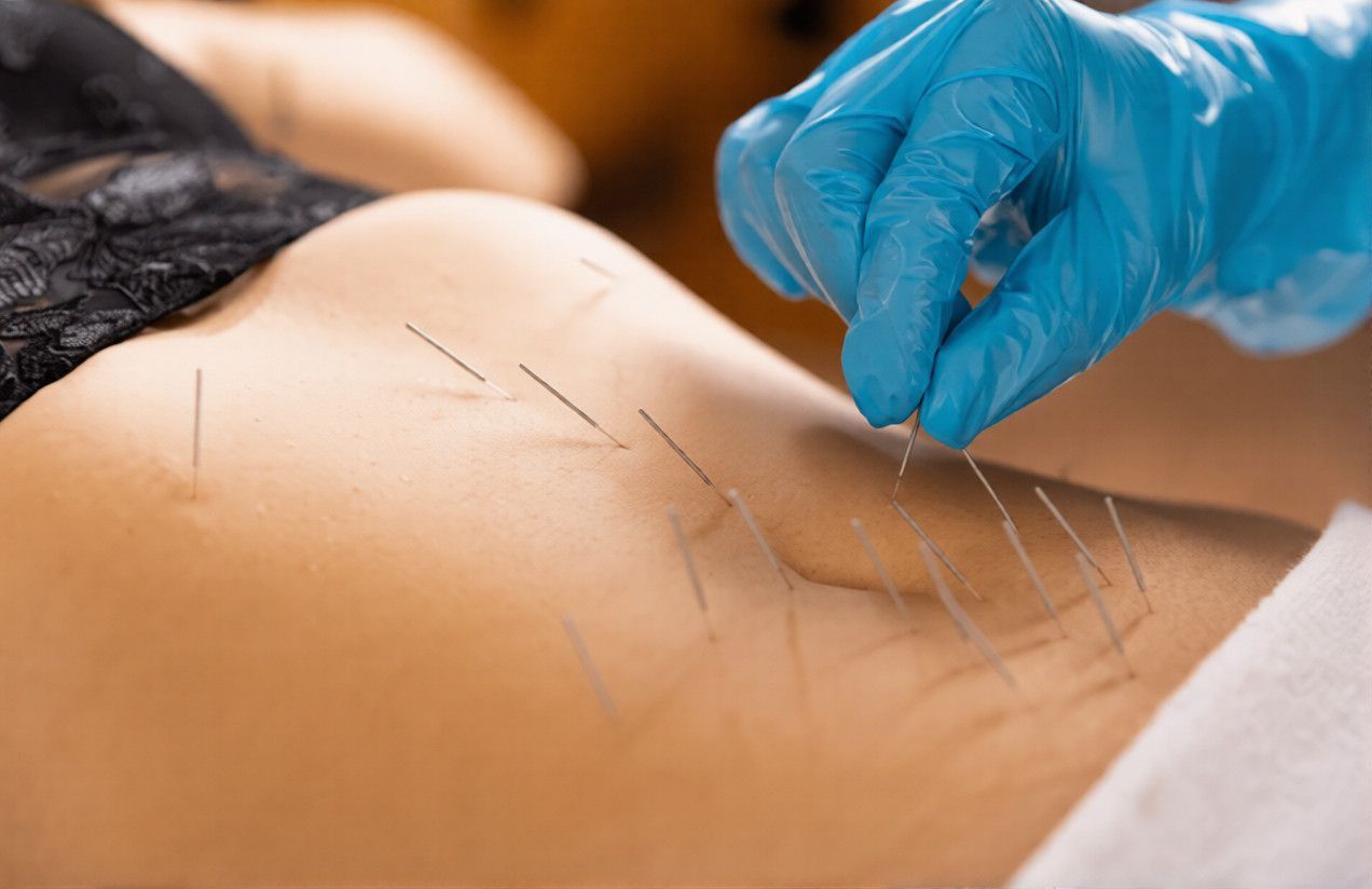 A person receives acupuncture treatment on their lower back, with gloved hands inserting needles.