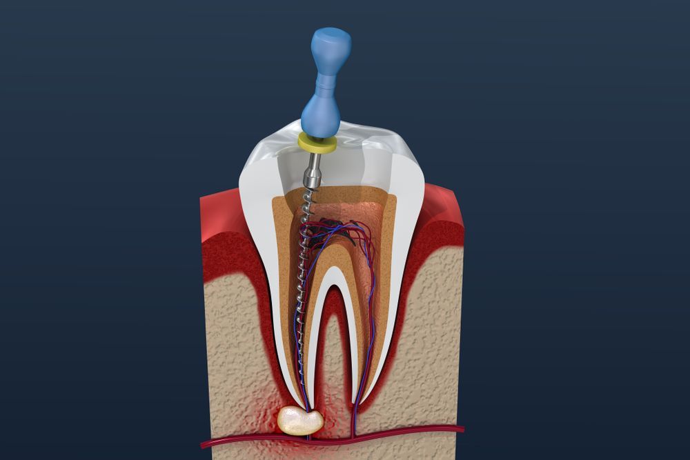 A 3d model of a tooth with a needle sticking out of it.
