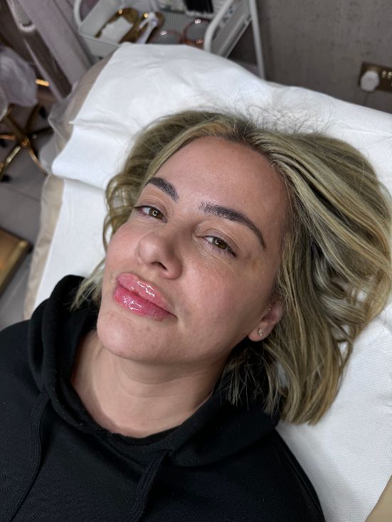Lip Filler | Flawless Beauty by Jodie