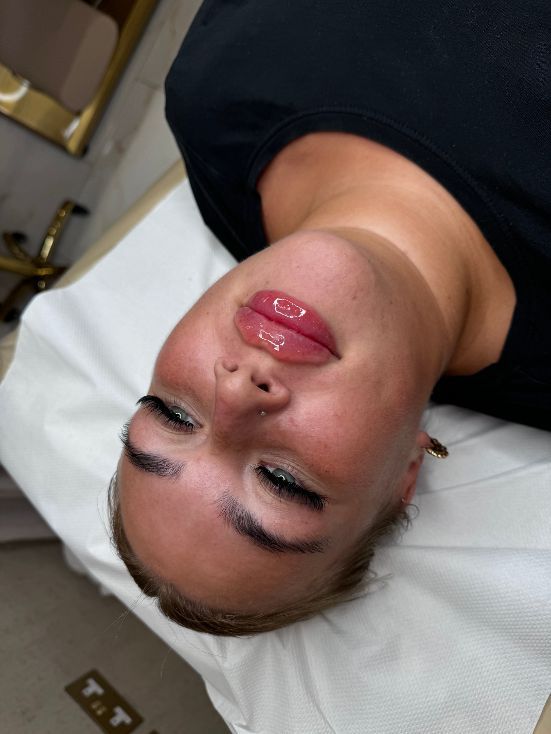 Lip Filler | Flawless Beauty by Jodie
