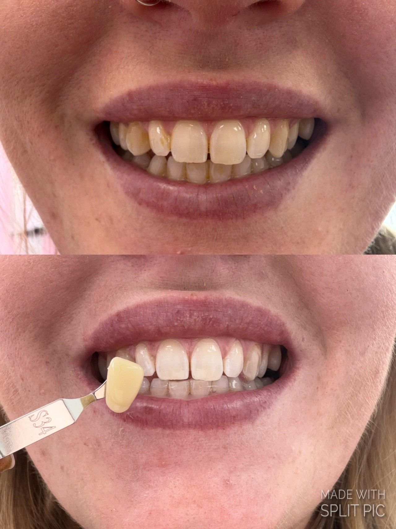 Teeth Whitening | Flawless Beauty by Jodie