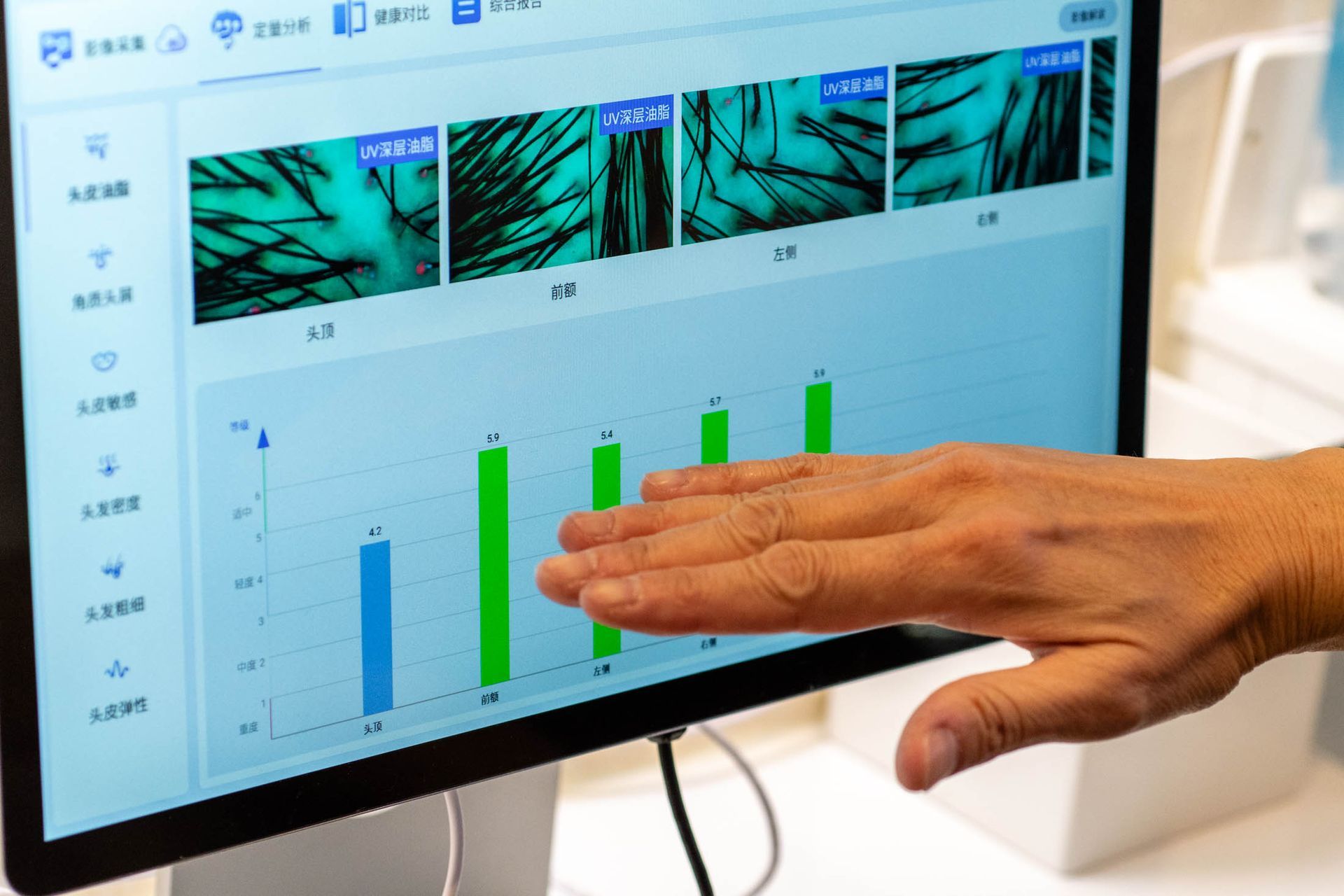 A person’s hand points at a computer monitor displaying microscopic images of hair follicles and a corresponding bar chart.