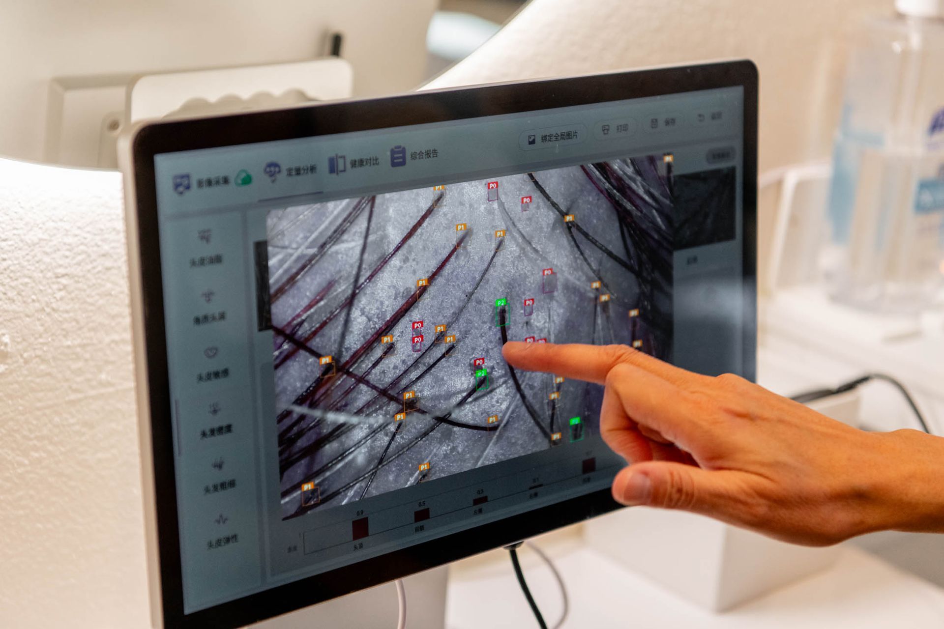 A hand points to a digital screen showing a magnified view of a scalp and hair follicles during a professional analysis.