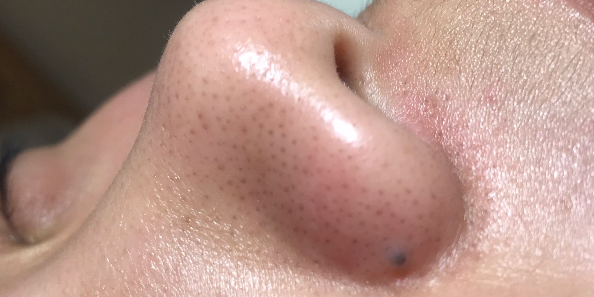鼻子特寫，鼻孔附近有個小黑點