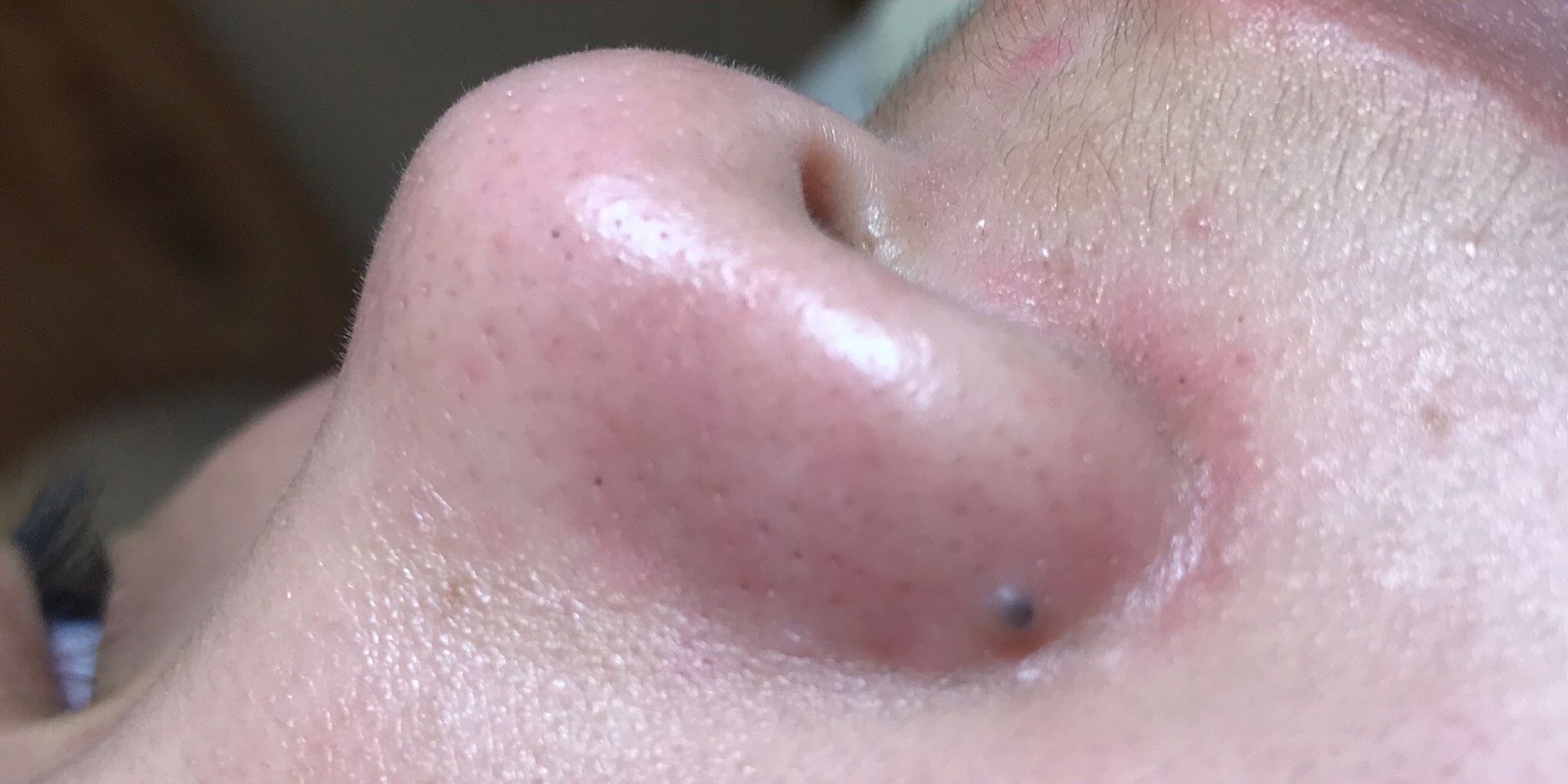 特寫鏡頭拍攝人的鼻子，鼻孔附近有一個小黑點。
