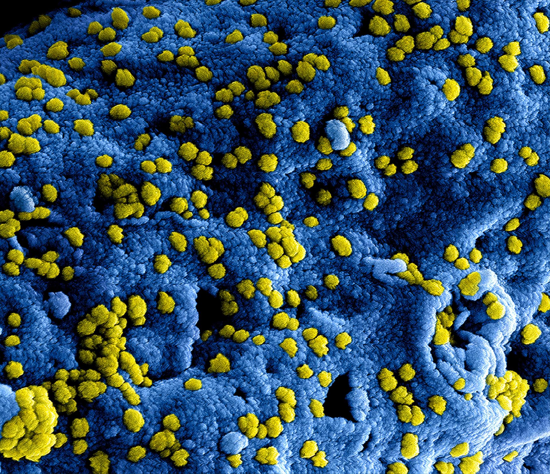 Bactérias aderidas à superfície de um implante. Texto sobre infecção após artroplastia do joelho.