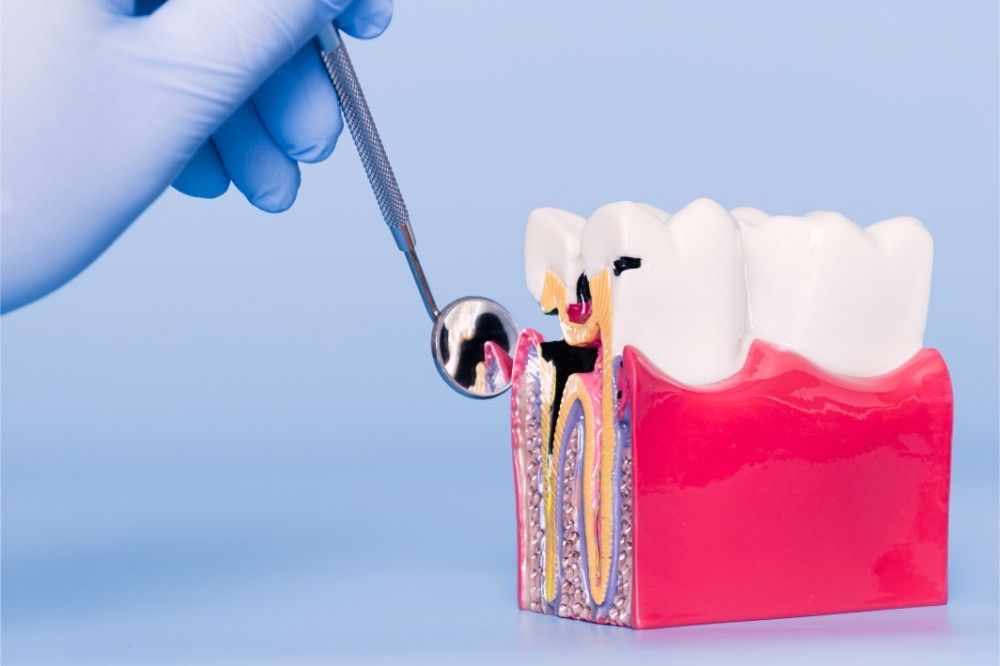 Diagnosi parodontite: Studio Dentistico Vecchiotti Cesena 0547 24741