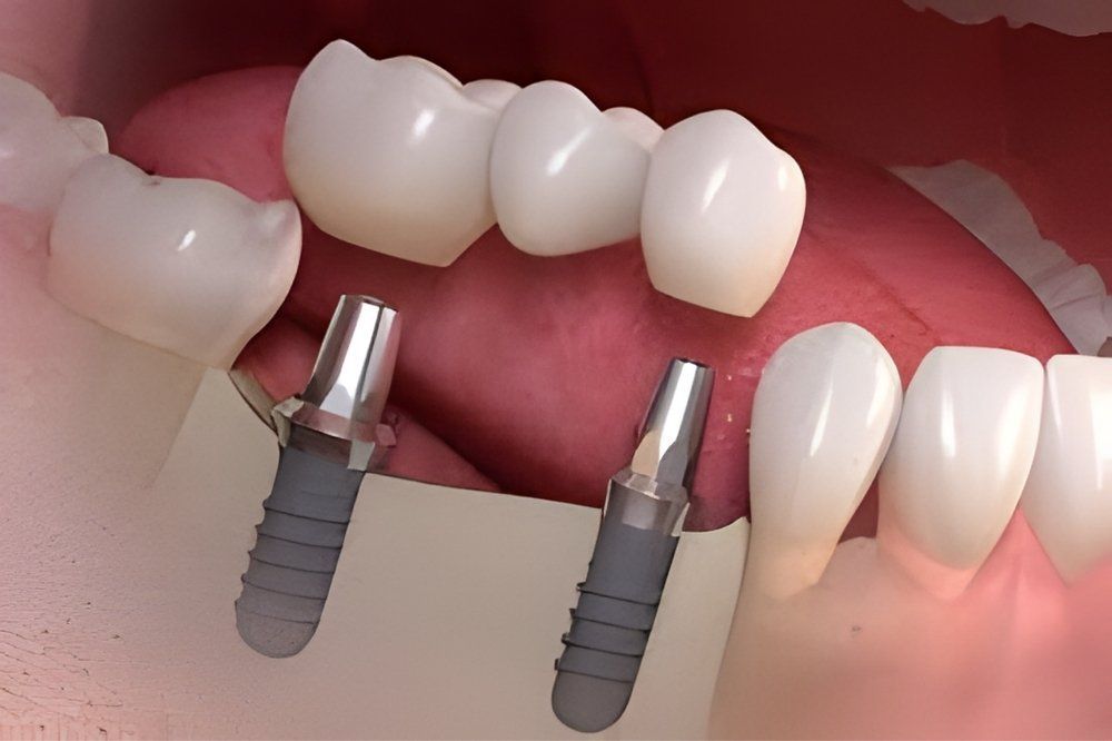 Cura delle Carie: Studio Dentistico Vecchiotti Cesena Cura delle Carie: Studio Dentistico Vecchiotti Cesena