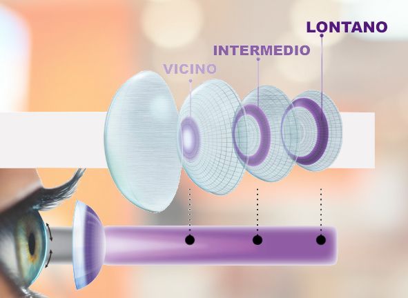 come funzionano le Lenti a contatto progressive - multifocali